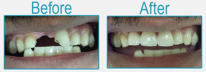 Puentes dentales antes y después 3