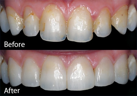 Decoloración dental antes y después del tratamiento de contorneado. Carson & Carson, DDS en Oxnard, California.