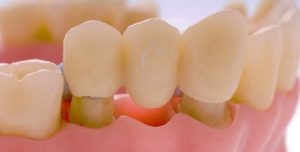 Puente dental de plástico parcialmente insertado