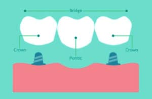 Colocación de puentes dentales sobre 2 pilares de implantes dentales.