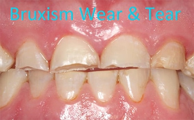 Bruxism - Teeth Grinding - Causes & Symptoms - Carson & Carson, DDS