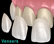 Gráfico de carillas dentales 3D