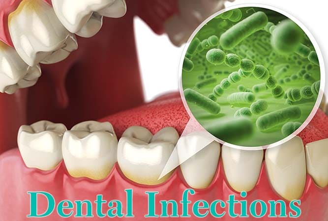 infection after dentist visit