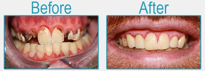 Antes y después de un cambio extremo de sonrisa