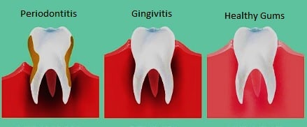 Ejemplos digitales de enfermedades de las encías Gingivitis y Periodontitis