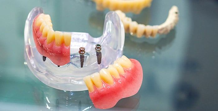 Mini dental implants with partial dentures