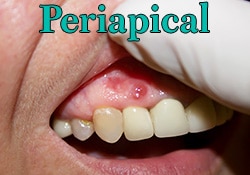 Periapical Cyst Treatment