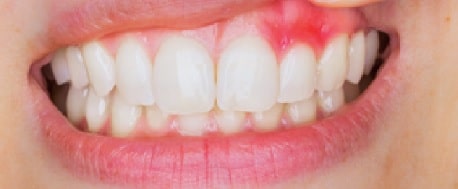 La gingivitis es la forma más leve y aún subsanable de la enfermedad de las encías. Más información sobre la enfermedad periodontal en CarsonDDS.com