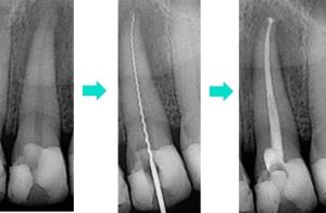 Diente candidato a endodoncia, extirpación de la raíz del diente, empaste tras la extirpación de la raíz