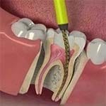 Tratamiento del conducto radicular