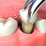 Servicios de extracción dental