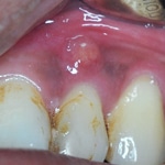 Infección dental - Absceso