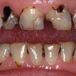 Caries y deterioro de los dientes