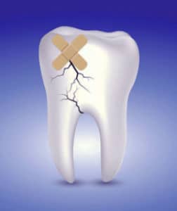 La reparación de un diente astillado puede hacerse 24 horas al día, 7 días a la semana, en la consulta del dentista de Oxnard Carson & Carson, DDS.