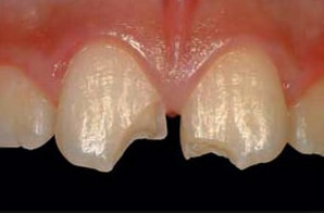 Dientes ligeramente astillados. Fácilmente reparable en Carson & Carson, DDS en Oxnard, California.