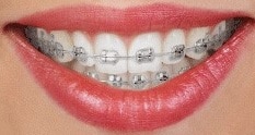 Brackets metálicos tradicionales disponibles en Carson & Carson, DDS en Oxnard, California.