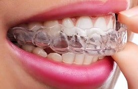 Los alineadores transparentes Invisalign son una alternativa fácil de usar a los aparatos de ortodoncia. Disponibles en el dentista de Oxnard Carson & Carson, DDS.